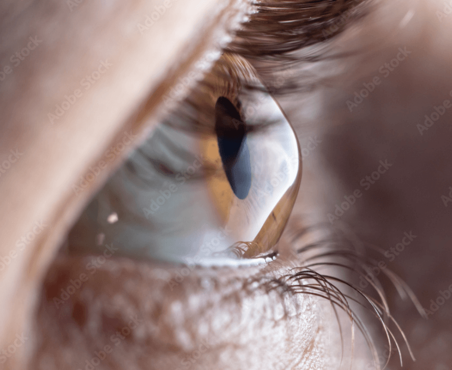 Keratoconus management SM Eye Institute in Ahmedabad Gujarat