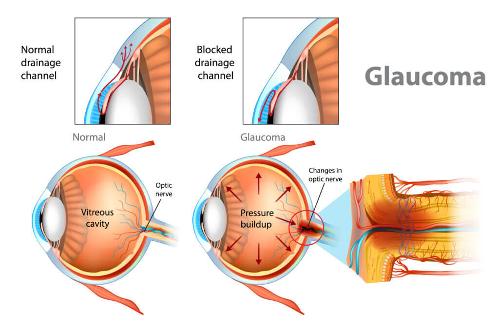 Glaucoma SM Eye Institute in Ahmedabad Gujarat