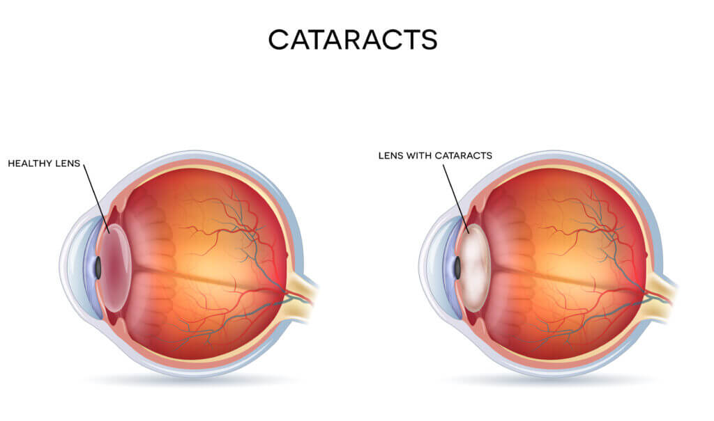 Cataracts SM Eye Institute in Ahmedabad Gujarat