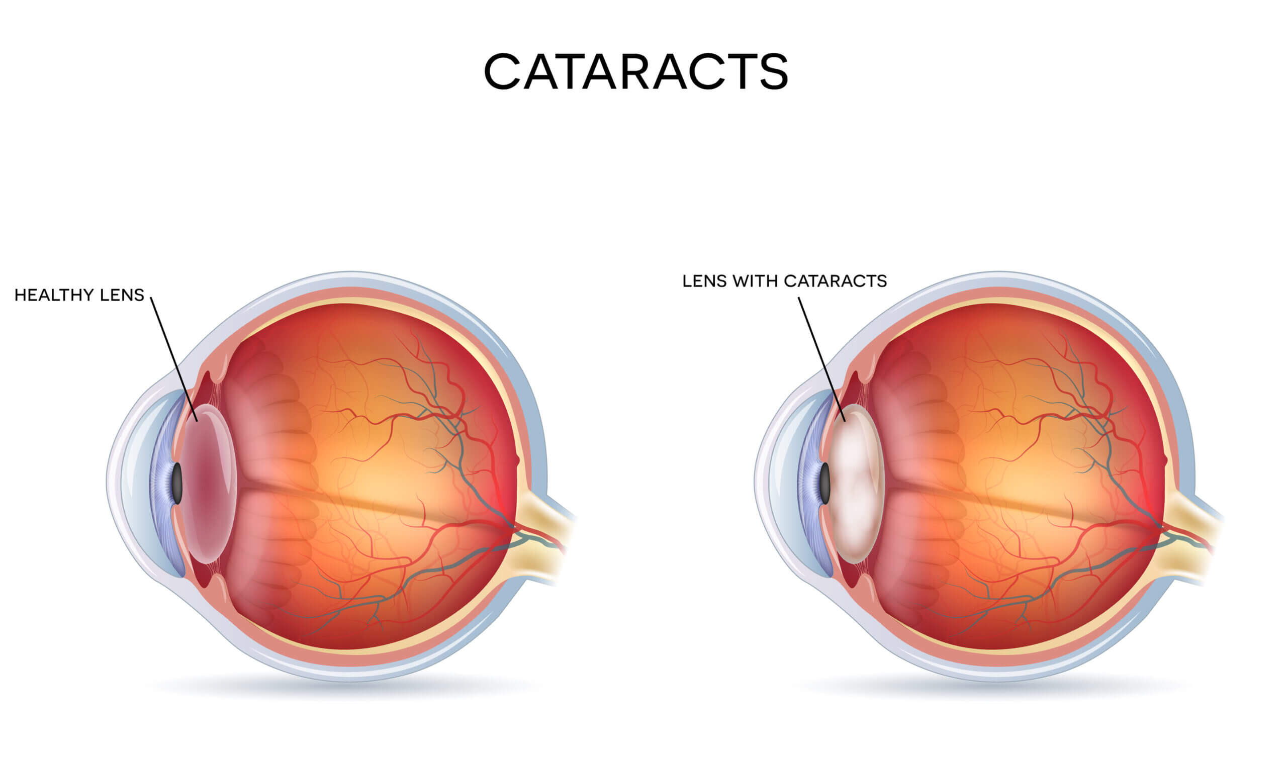 Understanding Cataract: Causes, Symptoms, and Treatment Options